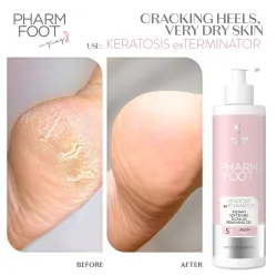 Keratosis exTerminator 300ml